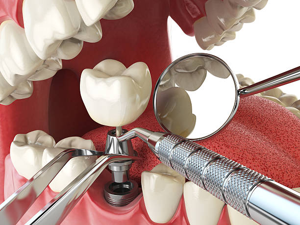 Best Emergency Tooth Extraction in Mogadore, OH